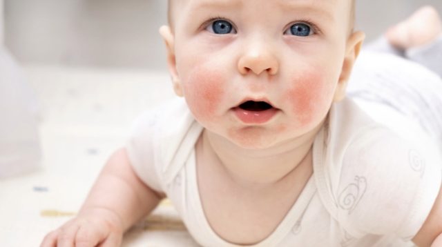 Kenali Gejala Dini Dermatitis Atopik pada Anak Sejak di Pipi dan Lipatan Kulit