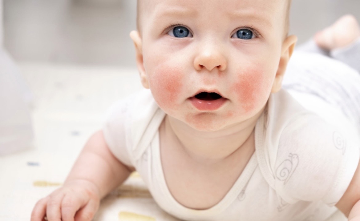 Kenali Gejala Dini Dermatitis Atopik pada Anak Sejak di Pipi dan Lipatan Kulit